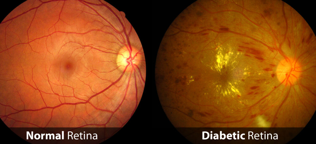 diabetic retinopathy vs normal eye
