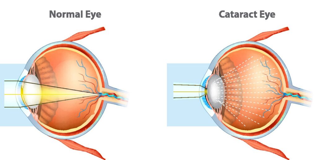 normal vs cataract eye