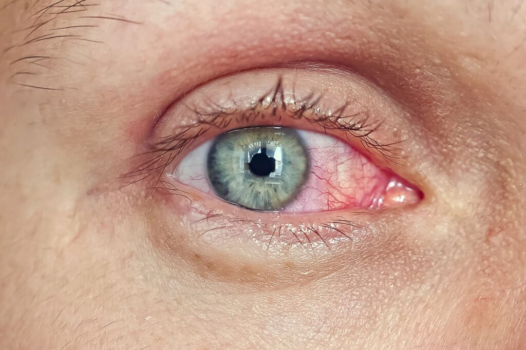 red eye from dry eye